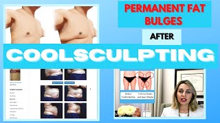 Permanent Fat Bulges After CoolSculpting Paradoxical Adipose Hyperplasia [upl. by Elkin]