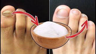 URGENT MIX THIS AND GOODBYE FUNGI ON NAILS Foot Fungus Natural Treatment [upl. by Grange227]