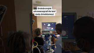 Endobronşial Ultrasonografi İle Lenf Nodu Örneklemesi  Prof Dr Elif Küpeli [upl. by Jon410]