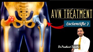 HIP AVN TREATMENT  HIP AVN MEDICAL TREATMENT  AVASCULAR NECROSIS [upl. by Aristotle826]