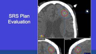 Radiation Therapy for Brain Tumors [upl. by Klayman]