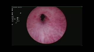 V9 Bulkamid Injection for Recurrent PostProstatectomy Stress Incontinence in a Male Patient [upl. by Kinemod]