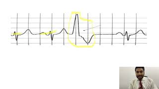 Mastering ECGLesson17 PVCs amp PACs  premature ventricular amp atrial contractions [upl. by Annawit]