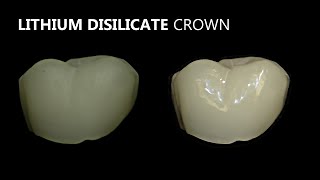 Porcelain Veneer Crown and Bridge Polishing [upl. by Lory929]