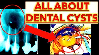 MASTERING Odontogenic Cysts TUTORIAL OKC Radicular Dentigerous Periapical Cyst Dental CBCT OPG [upl. by Tony137]