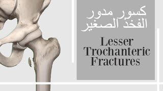 كسر ورك انقلاعي  كسر المدور الصغير للفخذ  lesser trochanteric fractures [upl. by Ardaid]