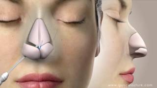 Rhinoplasty Nose Job Video Animation  Guncel Ozturk MD  DRGO [upl. by Eyssej]