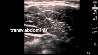 Ultrasound guided transversalis fascia plane block [upl. by Nodnol]