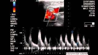 Duplex Exam of Moderate ICA Stenosis  Case Study [upl. by Enneiviv]