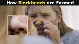 How blackheads are formed  Symptoms Causes And Treatment [upl. by Ai839]