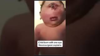 defect child born with conjoined eye neurosurgery neurosurgeon holoprosencephaly cyclopia [upl. by Davy]