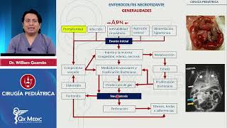 Enterocolitis necrotizante CIRUGÍA PEDIATRÍA INDICE DESCRIPCIONETIOLOGIACLINICATTO QXMEDIC [upl. by Canada594]