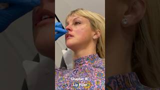 Lip fillers demo Watch me perform a subtle lip enhancement on this beautiful model 👄 shortsvideo [upl. by Danforth]