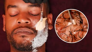 EXTREME Beard Care with SATISFYING Ingrown Hair removal [upl. by Mordy]