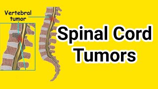 spinal cord tumors in Hindi  physiotherapy management of spinal cord tumors  spinal cord tumors [upl. by Noreen]