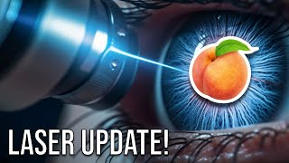 LASER Surgery Update  Hemorrhoids Anal Fistula Pilonidal Cyst [upl. by Palla]