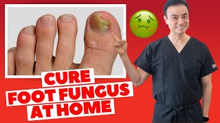 6 Effective HOME REMEDIES To CURE Toenail FUNGUS  Holistic Toenail Fungus Cures Part 2  Dr Kim [upl. by Oina]