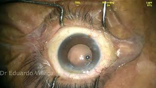 MONOFOCAL IOL EXCHANGE BY TRIFOCAL IOL  ANTERIOR CPASULE MEMBRANE REMOVAL [upl. by Repotsirhc]