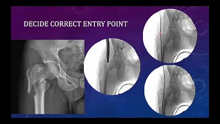 Basic technical tips for nailing of trochanteric IT femur fractures [upl. by Shabbir]