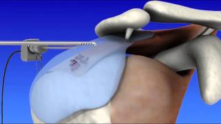 Shoulder Arthroscopy [upl. by Valerian]