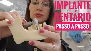 Implante Dentário Passo a Passo l Dra Danielle Sales [upl. by Jayne918]