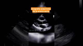 ANEURISMA DE LA ARTERIA AORTA ECOGRAFÍA ABDOMINAL [upl. by Sibella]