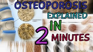 OSTEOPOROSIS  EXPLAINED IN 2 MINUTES  CAUSES  SYMPTOMS  TREATMENT  WHAT IS OSTEOPOROSIS [upl. by Paulsen367]