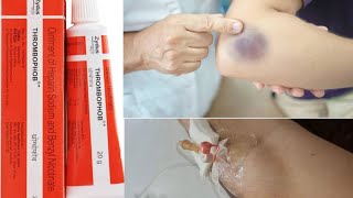 Thrombophob ointment  Treatment of Thrombosis  Superficial Blood Clotting  medicine information [upl. by Gwenneth]