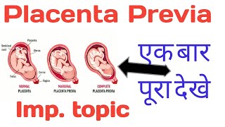 Placenta Previa in hindi [upl. by Melva621]