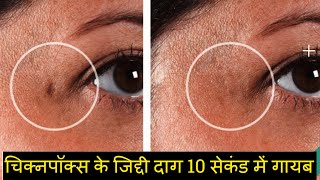 चिक्नपॉक्स के जिद्दी दाग कैसे मिटाए  Chicken Pox Scars Home Remedies in Hindi [upl. by Nipsirc288]