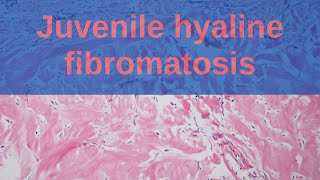 Juvenile Hyaline Fibromatosis  Pathology mini tutorials [upl. by Jermain913]