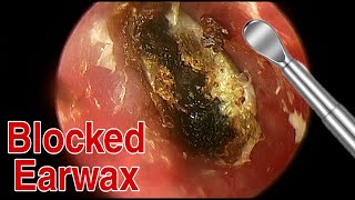 BIGGEST Ear Wax Difficult Removal  EP5  Doctor Anh [upl. by Eerhs]