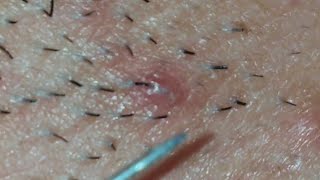 Biggest Ingrown Hair Removed from Beard 2019 [upl. by Eteragram]