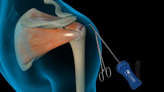 ConMed Linvatec Rotator Cuff Shoulder Surgery [upl. by Parthenia]