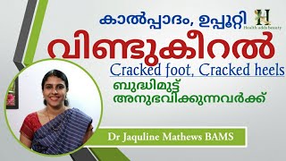 കാൽപ്പാദം വിണ്ടുകീറൽ ഉള്ളവർക്ക്  Cracked feet Cracked heels  Dr Jaquline Mathews BAMS [upl. by Tsirc119]