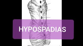 Hypospadias [upl. by Carline]