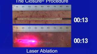 Tissue Thermal Ablation Pattern of ClosureFAST vs Laser [upl. by Yelac]