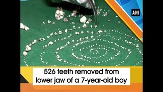 526 teeth removed from lower jaw of a 7yearold boy [upl. by Eugeniusz45]