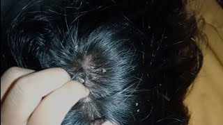 video satisfying relaxing  DRY SCALP big flakes dandruff scratching [upl. by Ahteres]