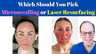 Should You Get Microneedling or Laser Resurfacing  Plastic Surgeons Advice [upl. by Yrrak]