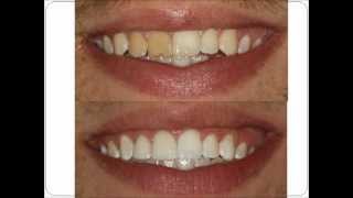 Spanish  Invisalign Teeth Whitening Dental Implants Bronx New York Dentistry Video  Musicwmv [upl. by Anrol128]