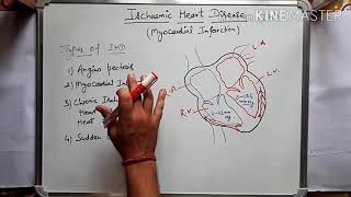 Ischaemic heart disease  Myocardial infarction in hindi Part1 [upl. by Racso502]