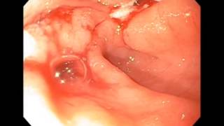 Gastric Outlet Obestruction from Pyloric Ulcers [upl. by Oxford260]