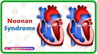 Noonan syndrome  Usmle step 1 [upl. by Sandy]