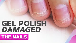 Badly Damaged Nails  Gel Polish Allergy Nail Plate Burn Onycholysis [upl. by Norha]