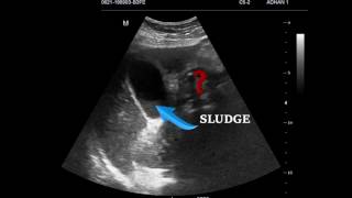 EMERGENCY ULTRASOUND IN RIGHT UPPER QUADRANT PAIN CASE 1 [upl. by Yevette]