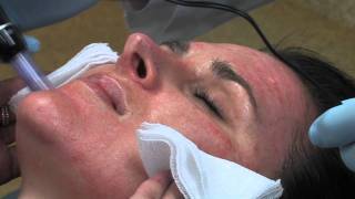 Dr Mark B Taylor Review of Dermapen Micro Needling  Gateway Aesthetics [upl. by Eirellam]