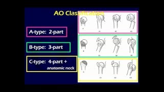 Proximal Humerus Fractures 1 OTA lecture series III u03a [upl. by Mathias]