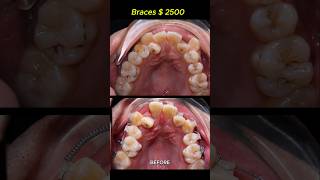 Cost  2500 for this case Braces crooked teeth braces orthodontist dentist [upl. by Analart894]