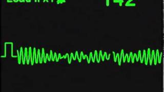 Fibrilacion Ventricular  Ventricular Fibrillation [upl. by Llehsram]